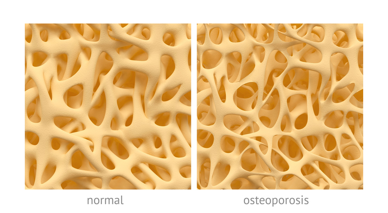 tulang dengan struktur normal dan dengan struktur osteoporosis